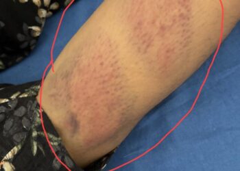 ਥਾਣਾ ਰੂੜੇਕੇ ਦੀ ਐਸਐਚਓ ‘ਤੇ ਔਰਤ ਨੂੰ ਨਜਾਇਜ਼ ਹਿਰਾਸਤ ਵਿੱਚ ਰੱਖਣ ਤੇ ਕੁੱਟਮਾਰ ਦੇ ਦੋਸ਼…ਜ਼ਖ਼ਮੀ ਔਰਤ ਜੇਰੇ ਇਲਾਜ