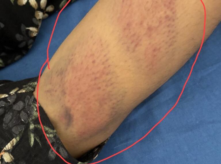 ਥਾਣਾ ਰੂੜੇਕੇ ਦੀ ਐਸਐਚਓ ‘ਤੇ ਔਰਤ ਨੂੰ ਨਜਾਇਜ਼ ਹਿਰਾਸਤ ਵਿੱਚ ਰੱਖਣ ਤੇ ਕੁੱਟਮਾਰ ਦੇ ਦੋਸ਼…ਜ਼ਖ਼ਮੀ ਔਰਤ ਜੇਰੇ ਇਲਾਜ